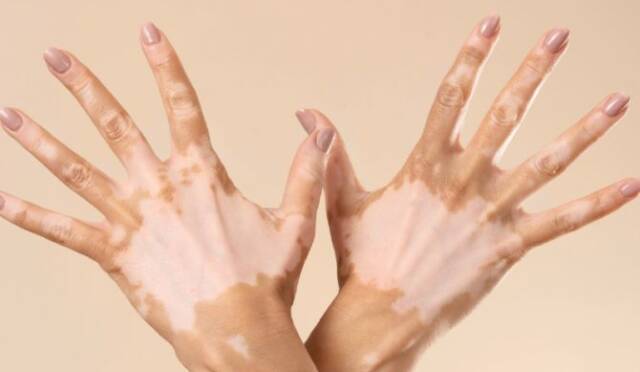 Vitiligo Nedir? Vitiligo Nasıl Tedavi Edilir?