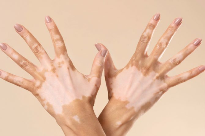 Vitiligo Nedir? Vitiligo Nasıl Tedavi Edilir?