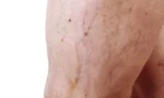 Bacaklardaki Varisler Zararlımıdır Kalbe Zararlımıdır